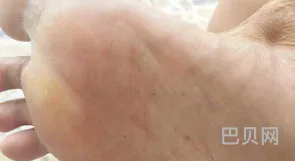 脚痒特别是晚上越抓越痒(脚气痒的睡不着快速止痒)